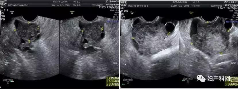 乳腺癌卵巢转移病例,乳腺癌病例分析ta2