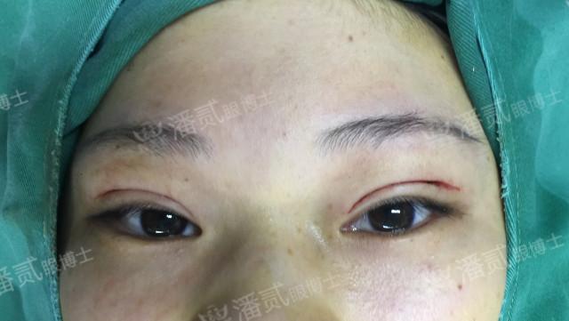 什么样的肿眼泡适合全切,什么样的肿眼泡不用动提肌