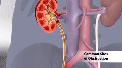 尿路结石知识,尿路结石影像