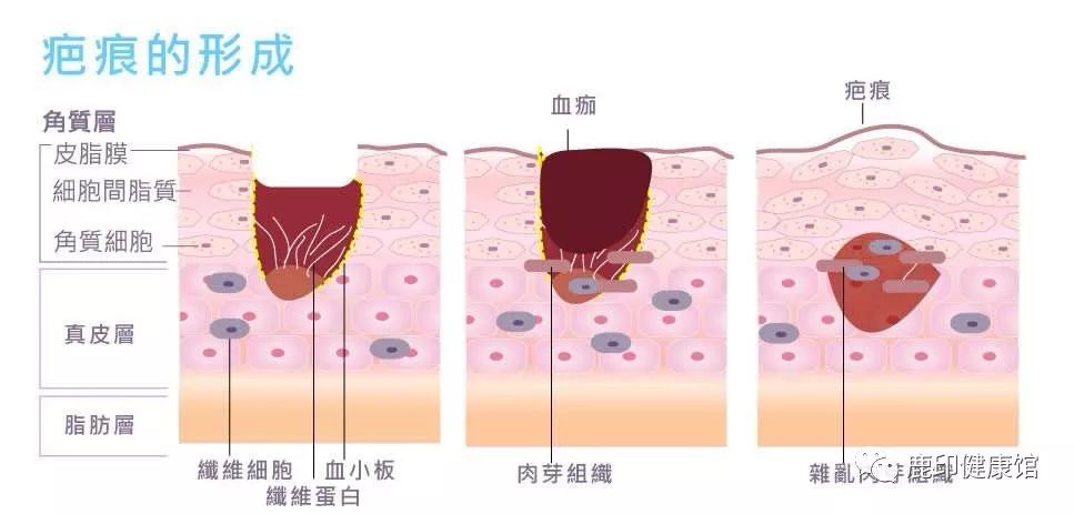 一不留神就崴脚，过几天脚不疼就是好了吗？