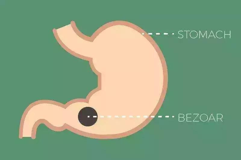 疼起来要命！有这三种结石要及早重视