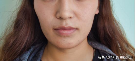 法令纹不做医美可以去除吗,祛除法令纹做什么手术效果好