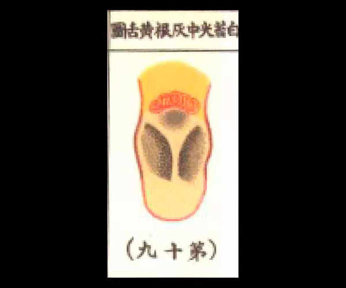 白苔厚腻有湿热的可能吗,舌根和舌中有黄腻苔中医辨证