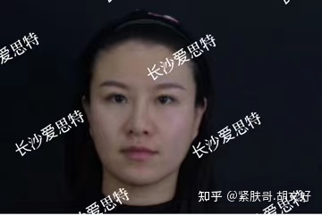 哪些人群不适合做热玛吉？