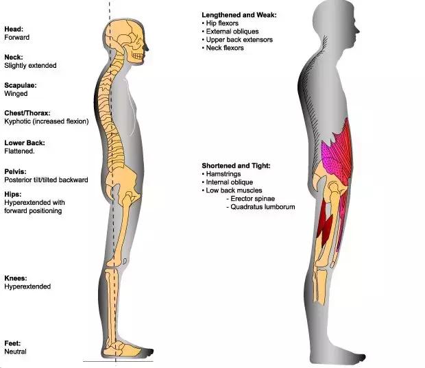 骨盆前倾后倾侧倾危害,骨盆后倾的普拉提训练动作有哪些