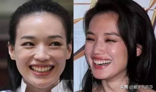 毁灭式的露龈笑也能重获笑容自由,毁灭式