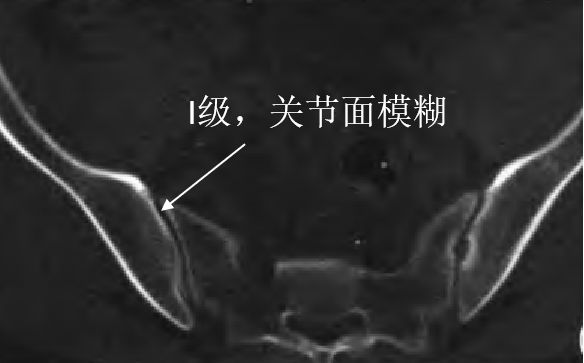 强直性脊柱炎骶髂关节二级改变,强直性骶髂关节炎等级