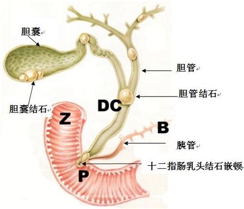 胆囊壁毛糙可以确定是胆囊炎吗,b超显示胆囊壁欠光滑是胆囊炎吗