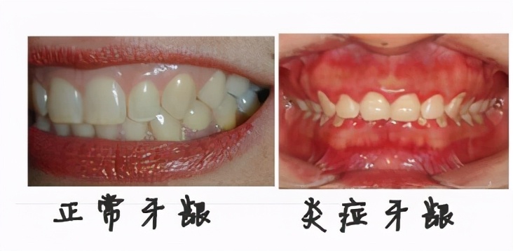 洗牙后牙龈一直出血用什么药止血,洗牙后出血凝结成血块包住了牙齿