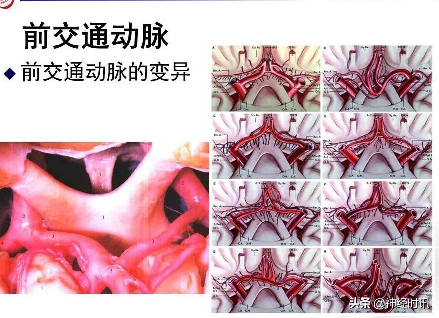脑动脉解剖学讲解,基底节区脑血管解剖