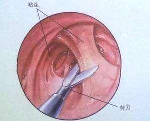 子宫腺肌病怎么治疗粘连,胎盘粘连会造成子宫腺肌症