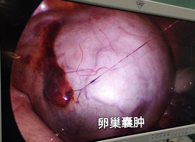 怀孕卵巢囊肿蒂扭转孩子能保住吗,怀孕卵巢囊肿扭转手术怎么做