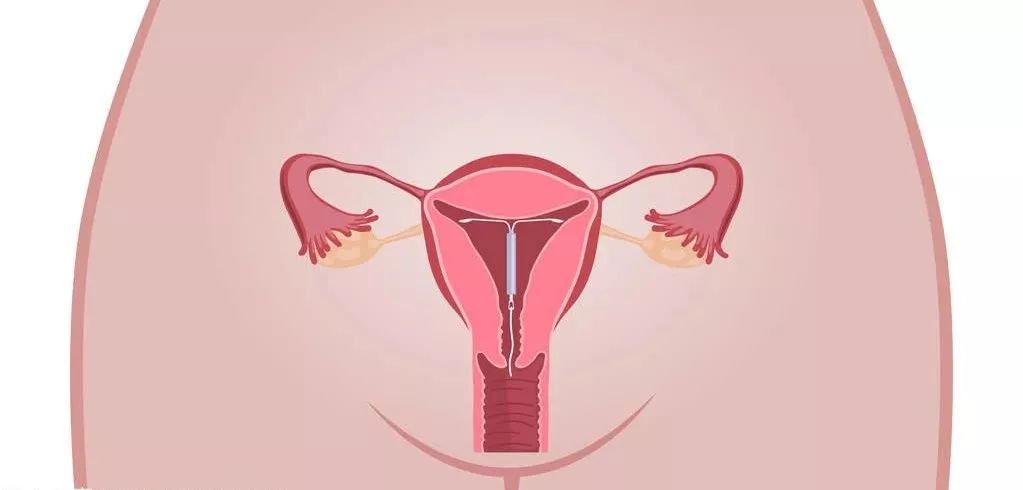 各种类型避孕药的区别,各种避孕药药丸类型