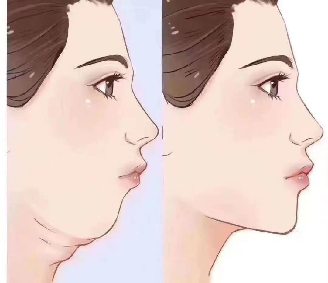 垫下巴能改善脸方吗,下巴短平可以垫下巴吗
