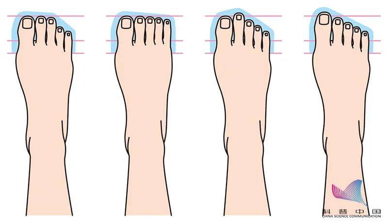 脚趾缝隙长鸡眼穿什么样的鞋合适,女人为什么喜欢穿尖头鞋