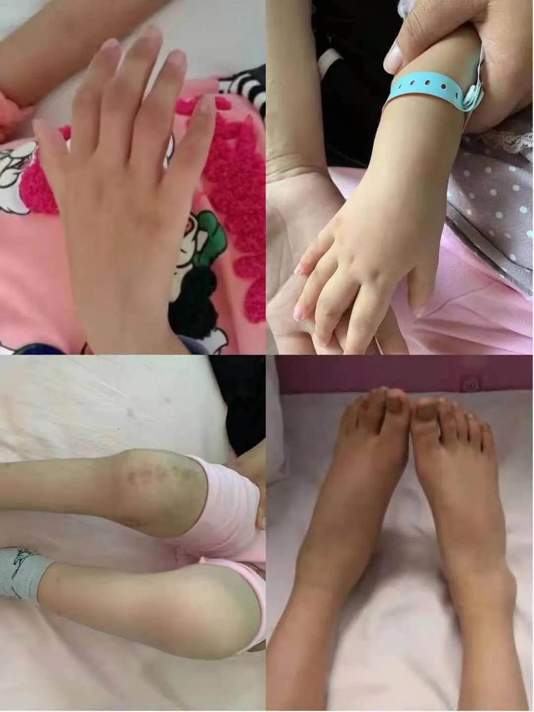 世界关节炎日简介,世界关节炎日义诊布置