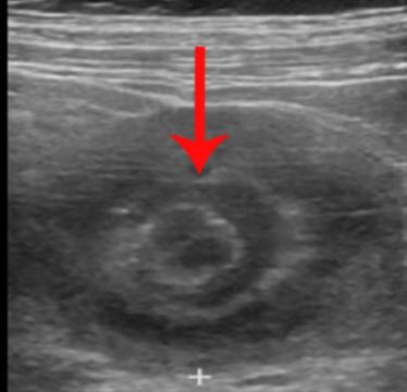 便血可触及腹部包块,肠套叠肚子轻微疼痛