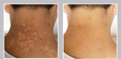 夏天到了身上流汗痒怎么解决,夏天到了总是大汗淋漓怎么缓解