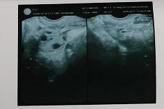 什么是葡萄胎形成原因是什么,28岁女子怀孕7个月