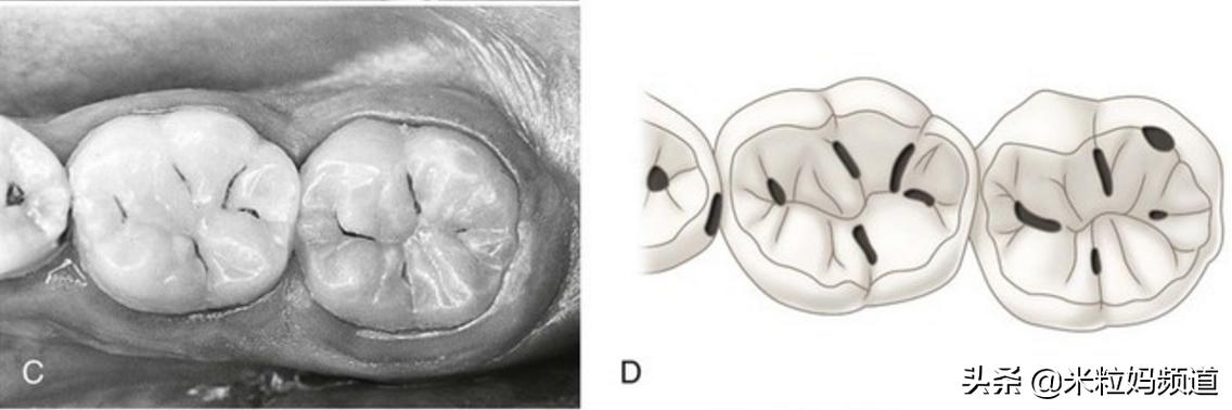 小朋友的蛀牙是怎么形成的,10岁小孩有7颗蛀牙