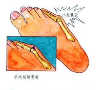 小脚趾拇囊炎的治疗方法,小脚趾侧边肿痛用什么药