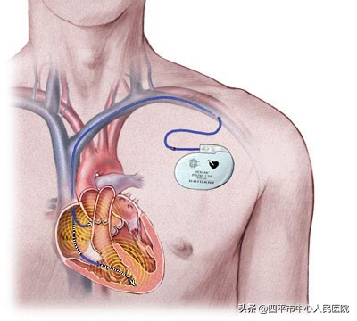 起搏器安装后要注意什么,加装心脏起搏器注意事项