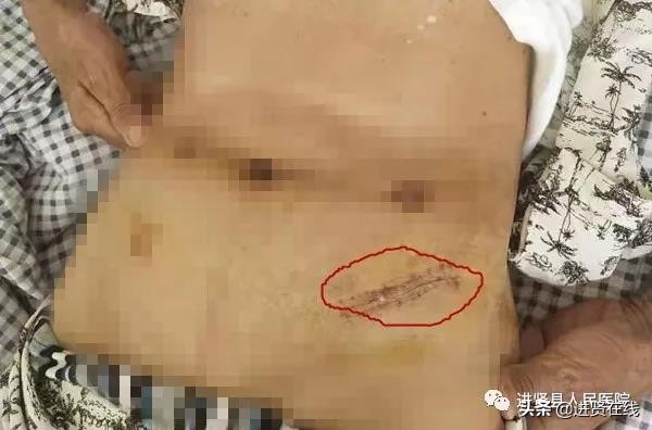 县医院成功进行腹腔镜手术,腹腔镜术后十天