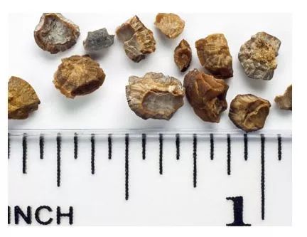 体外冲击波碎石后几天石头排出来,科普什么是石头