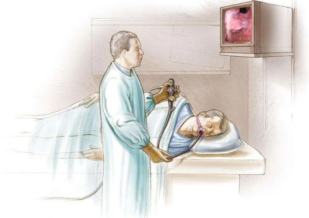 消化内镜技术近5年的新进展,腹腔镜下胆总管切开取石术恢复快