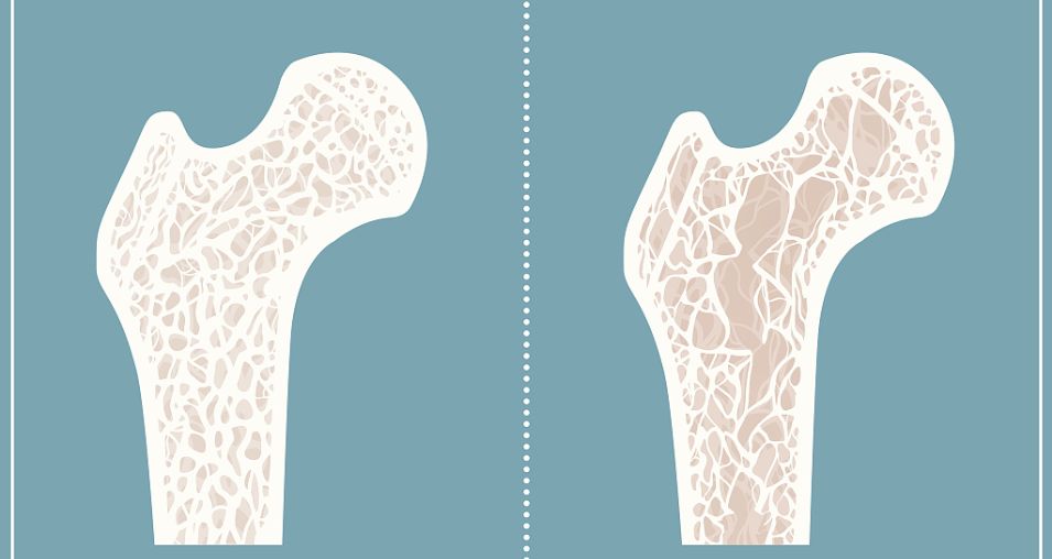 强直不锻炼,强直可以不吃药仅靠锻炼吗