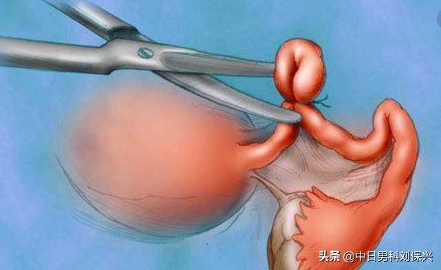 结扎后有自己恢复的吗,结扎后身体真的会变差