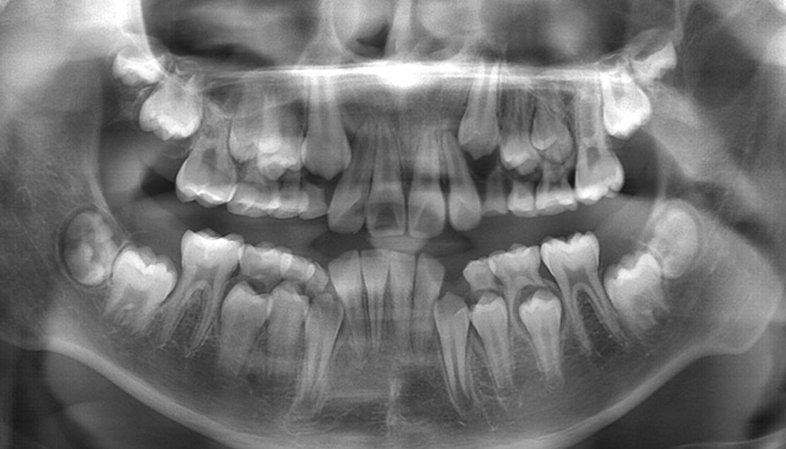10岁孩子牙掉1年还不长,孩子不长牙了怎么办