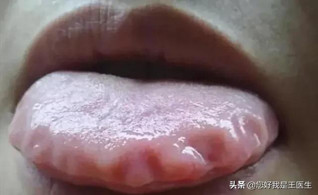 舌边有齿痕舌中有裂纹脾虚怎么办,舌边有齿痕中间有裂纹是什么原因