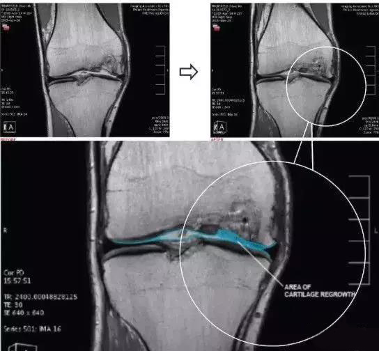 干细胞治疗膝关节疼痛案例,膝关节注射干细胞后疼痛持续多久