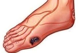 糖化血红蛋白7.7血糖高8.87严重吗,糖化血红蛋白高7.25影响试管吗