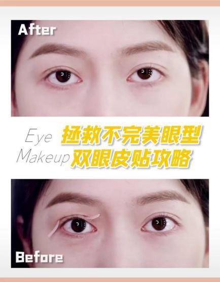 大小眼可以用双眼皮贴改善吗,双眼皮贴调整眼型