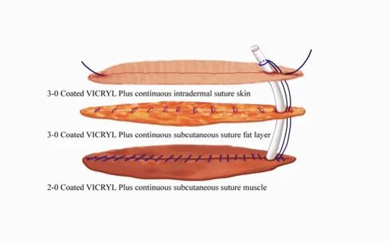 面部微创美容手术,面部免拆线美容缝合