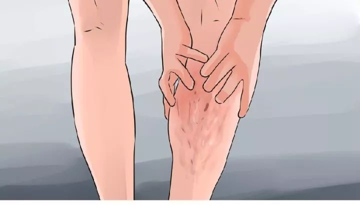 有什么治疗小腿静脉曲张的好方法,小腿静脉曲张的最快消除方法