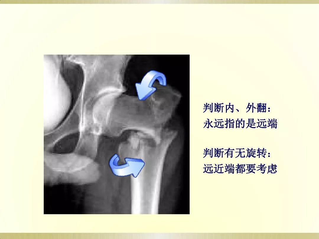 骨科x光片读片技巧,放射科骨科读片教程