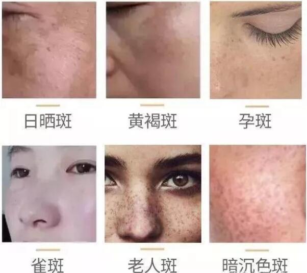 了不起的美白祛斑霜,了不起的国货去除痘印