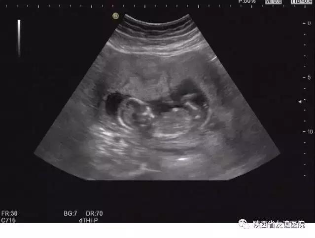 孕妇超声检查不良影响,孕妇超声检查的几大误区