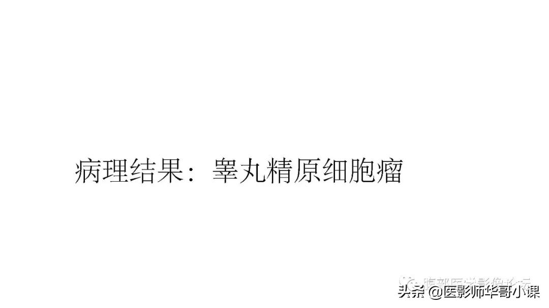 [精品课件]畸胎瘤及精原细胞瘤（*丸睾**肿瘤及肿瘤样变CT及MR表现）