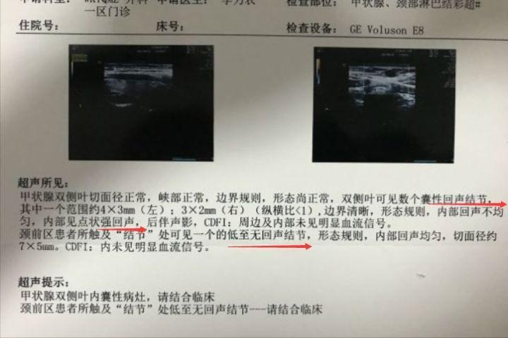 甲状腺b超片状低回声是什么意思,甲状腺b超回声不均匀意味什么