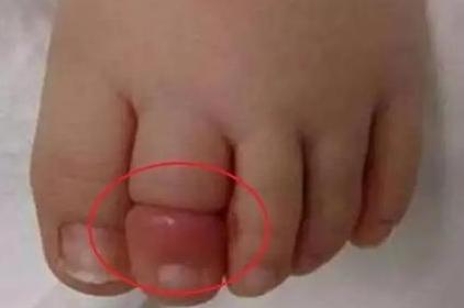 四岁孩子脚趾疼得很厉害,4岁孩子脚趾