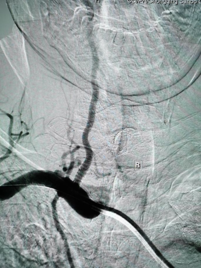 急性脑梗死支架取栓用开颅吗,急性脑梗死支架取栓视频