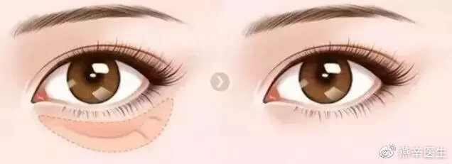 科普篇眼部整形的七大误区,关于眼整形这些事你一定要知道