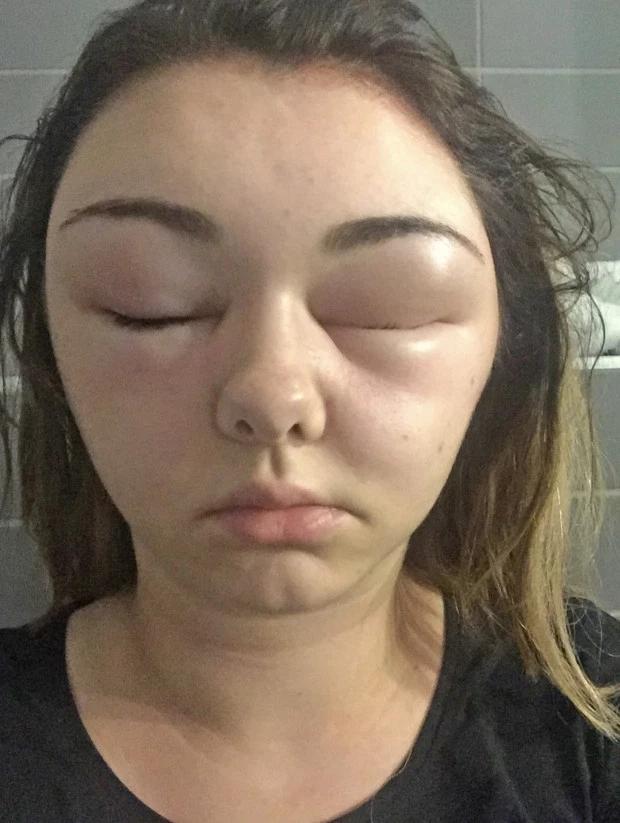 浙江杭州一女子染发过敏,染发剂导致眼睛失明