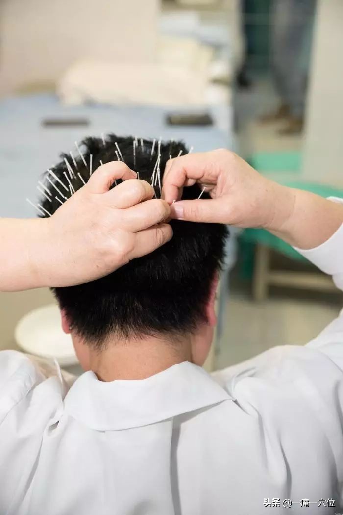 头顶疼痛怎么治疗最快最有效,头顶痛的最佳解决办法