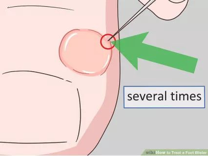 怎么预防跑步起水泡,一到夏天跑步脚就起泡怎么办