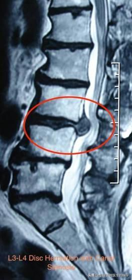 有些患者膝盖疼痛是由腰椎间盘突出压迫神经导致的,千万别忽视